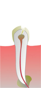 Root Canal procedure: unhealthy tooth, drilling, filing, rubber filling.