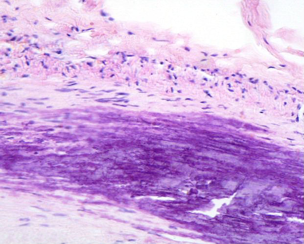 atherosclerotic plaque