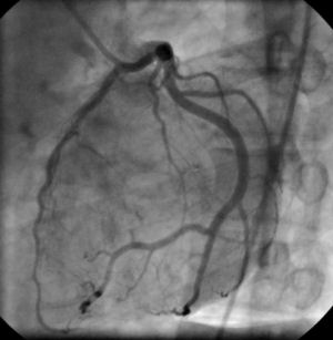 cardiac catheterization