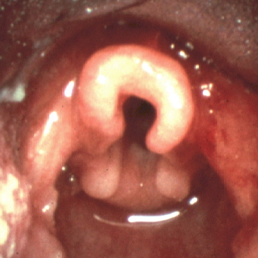 omega shaped epiglottis